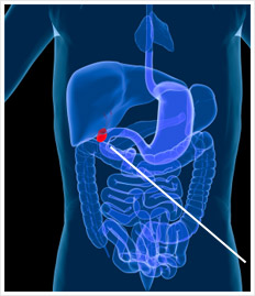gallbladder surgery - annapolis